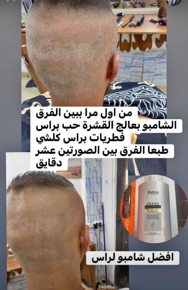 فيدباك شامبو فالورا للقشرة